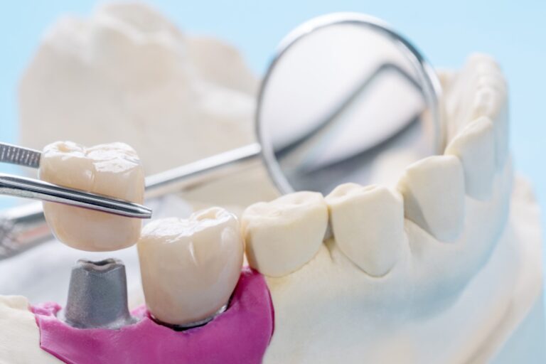que es un puente dental – dientes que es un puente dental - dientes