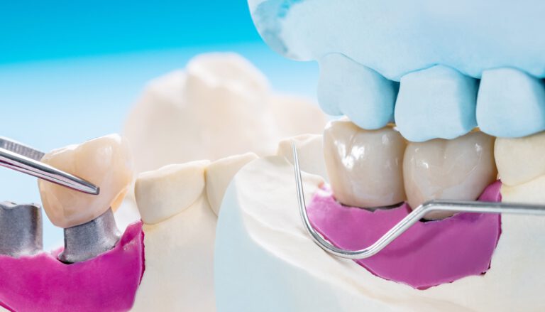 ¿Qué Es Un Puente Dental Y Para Qué Sirve? - Like Dental