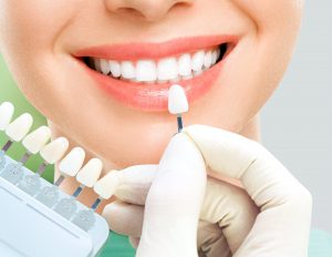 blanqueamiento dental en Majadahonda - definicion de color