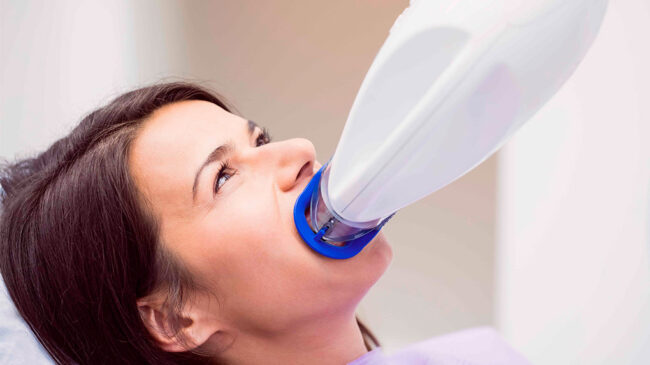 blanqueamiento-dental-en-majadahonda---proceso