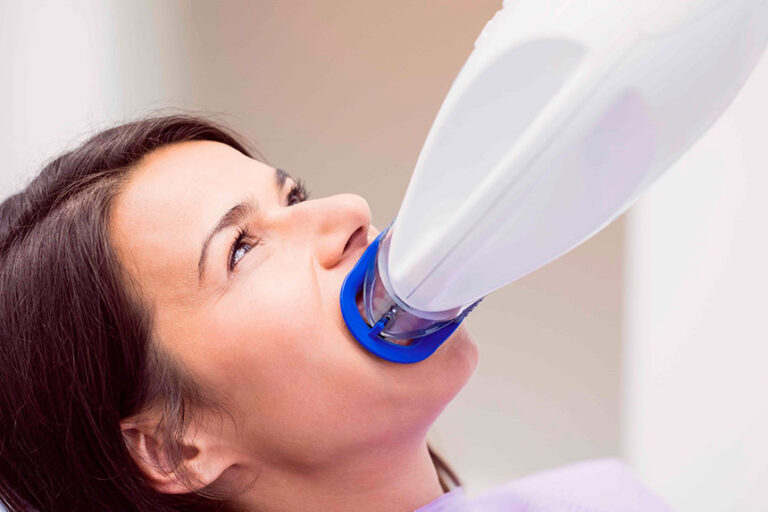 blanqueamiento-dental-en-majadahonda—proceso blanqueamiento-dental-en-majadahonda---proceso