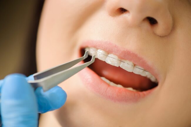 ortodoncia majadahonda - modificación-