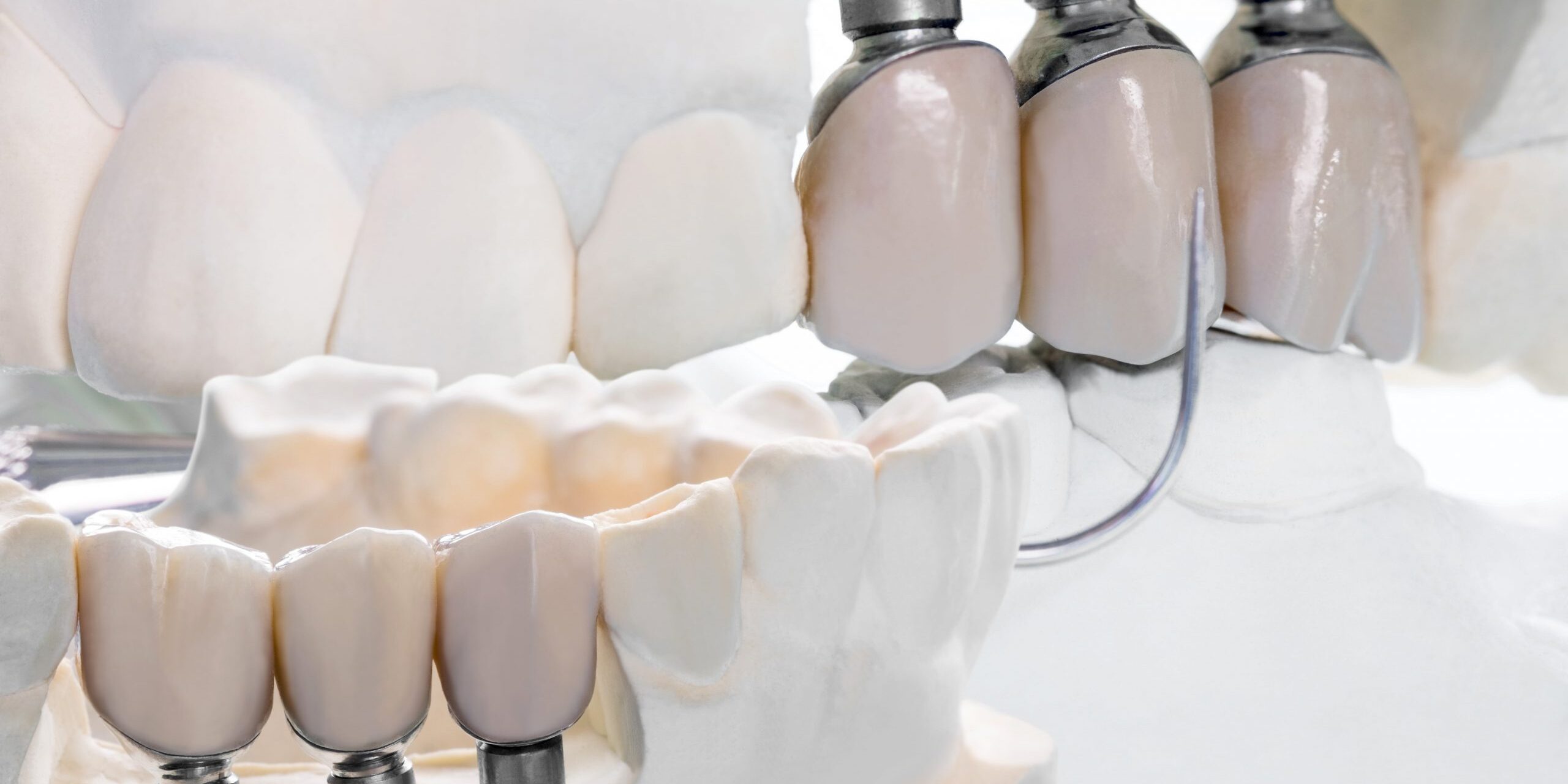 protesis dental brunete – prototipo- protesis dental brunete - prototipo-