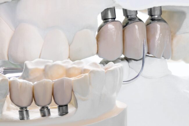 protesis dental brunete - prototipo-