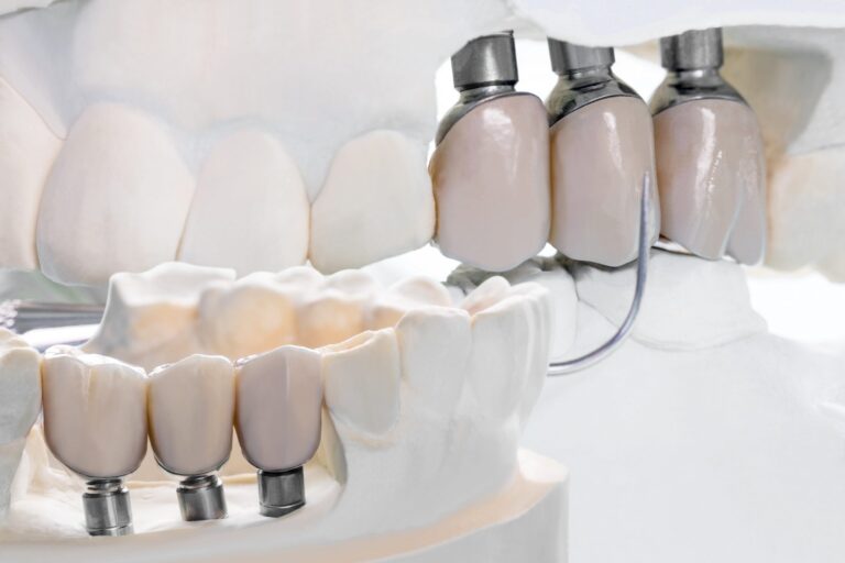 protesis dental brunete – prototipo- protesis dental brunete - prototipo-