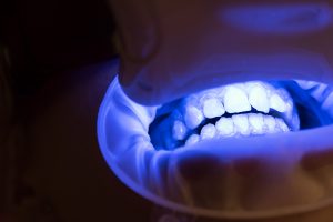 qué es el blanqueamiento dental con luz fría - dientes