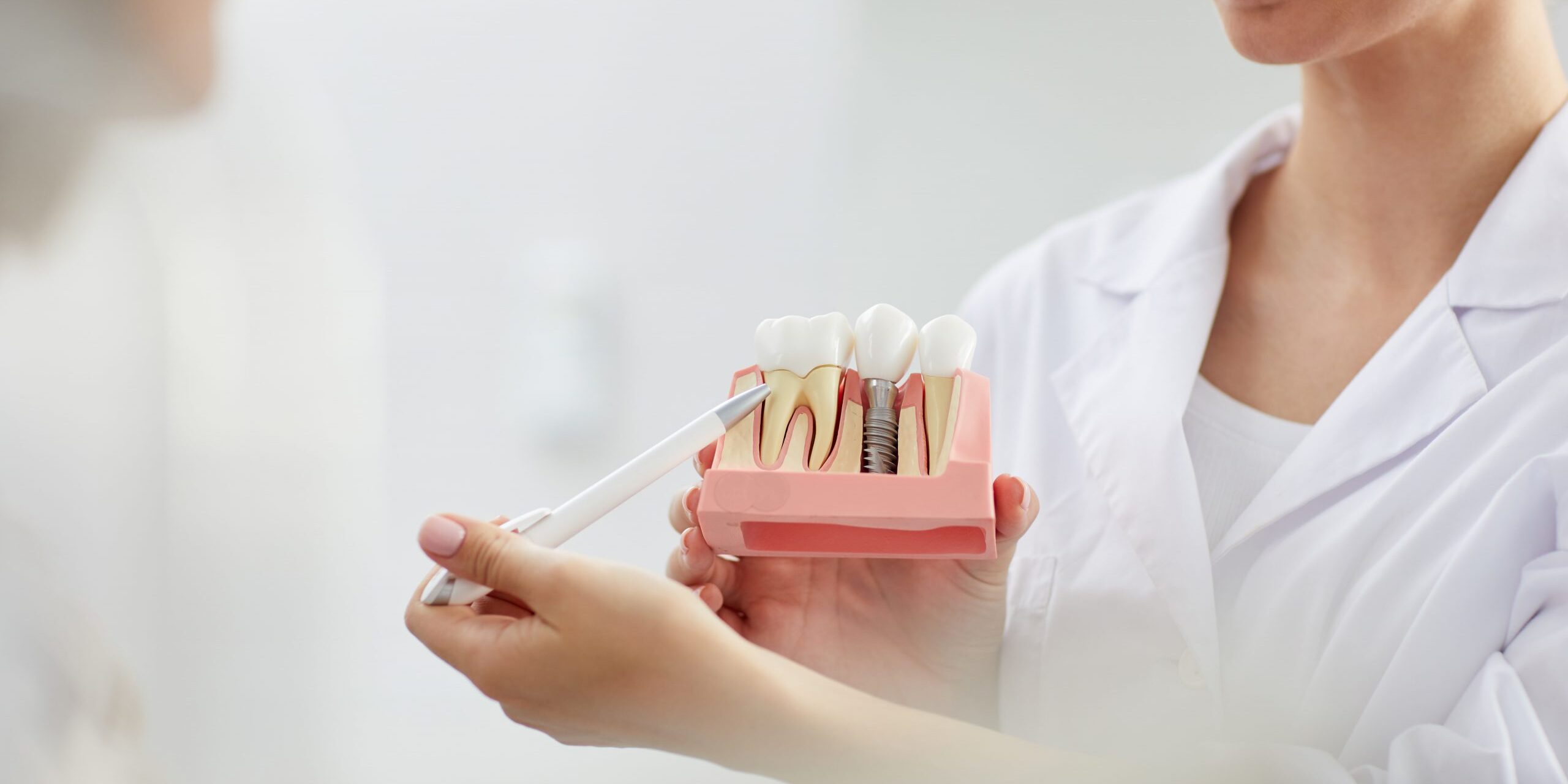 qué es el implante inmediato – explicación qué es el implante inmediato - explicación