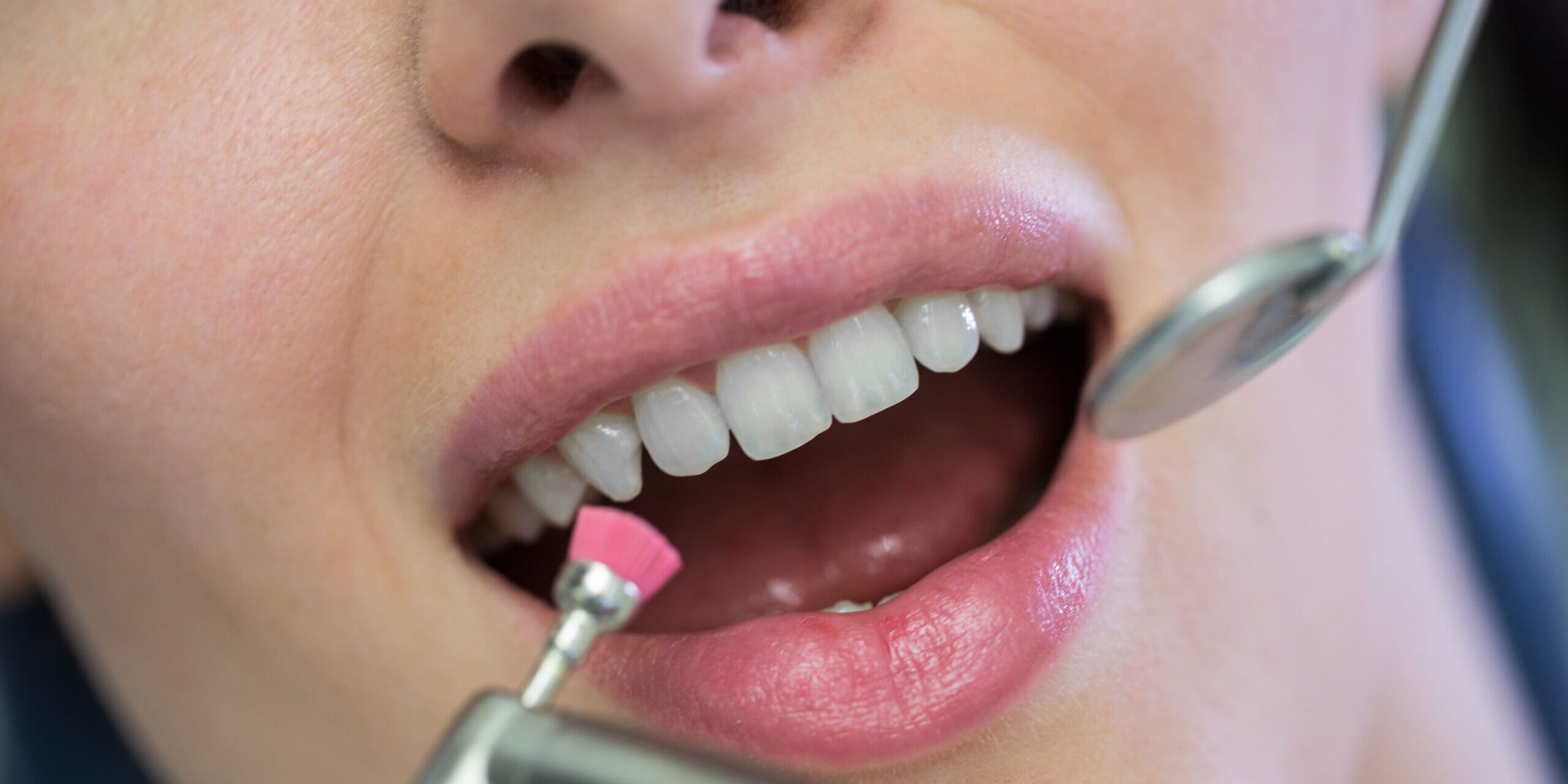 qué es el sarro – Limpieza dental qué es el sarro - Limpieza dental