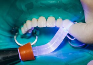 qué son las carillas dentales - colocacion de carillas