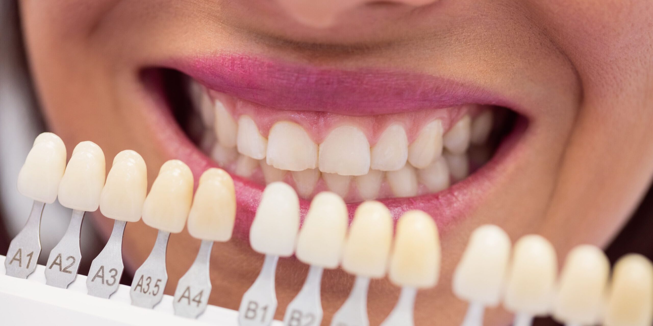 qué son las carillas dentales – seleccion del color qué son las carillas dentales - seleccion del color