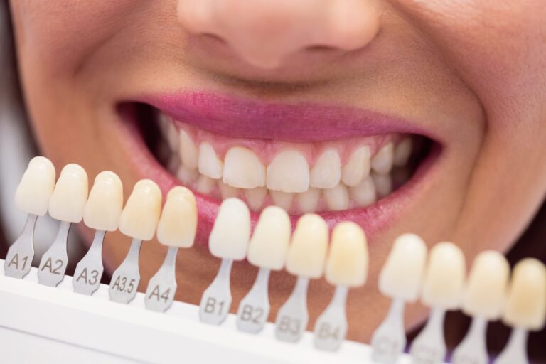 qué son las carillas dentales – seleccion del color qué son las carillas dentales - seleccion del color