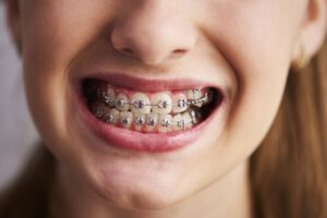 ortodoncia Brunete - niÃ±a con ortodoncia