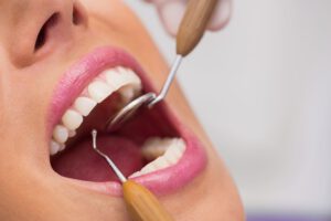 importancia de acudir a la limpieza dental anua - limpieza del sarro
