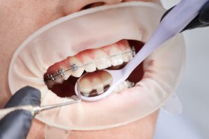 clínica dental en Brunete - tratamiento de ortodoncia
