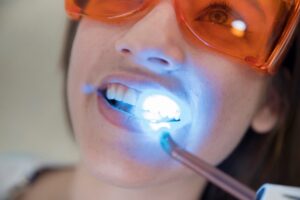 tipos de blanqueamiento dental - luz