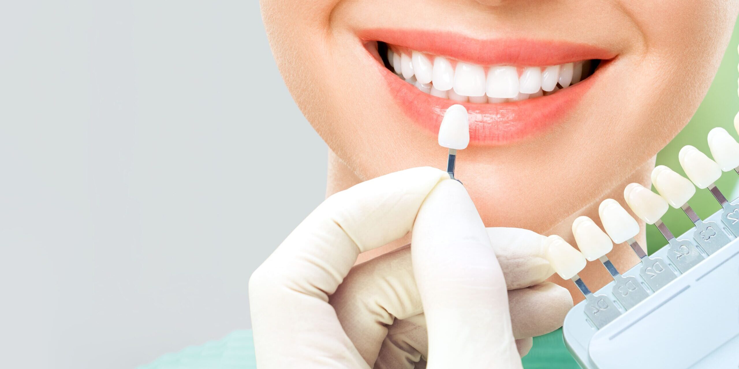 Por qué optar por ponerte carillas dentales – seleccion del color Por qué optar por ponerte carillas dentales - seleccion del color