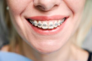 tipos de ortodoncia que existen - sonriendo