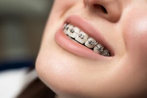 Ortodoncia en Villanueva de la cañada - mujer brackets grises