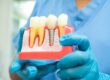Prótesis dental en Villanueva de la cañada - muestra de protesis tornillo