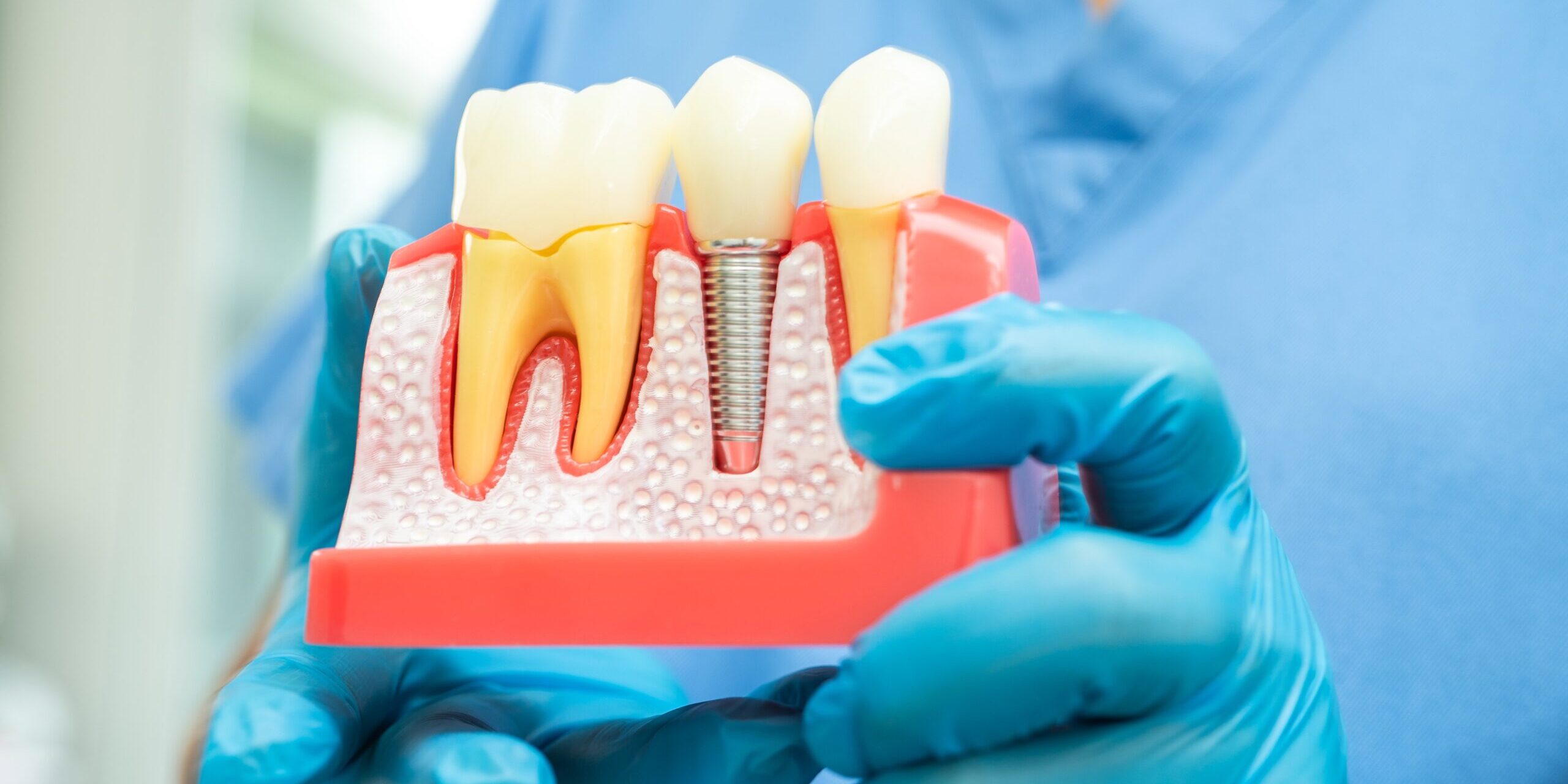 Prótesis dental en Villanueva de la cañada - muestra de protesis tornillo