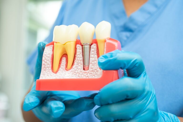 Prótesis dental en Villanueva de la cañada – muestra de protesis tornillo Prótesis dental en Villanueva de la cañada - muestra de protesis tornillo