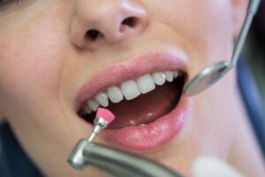 importancia de acudir a una limpieza dental anual - mujer