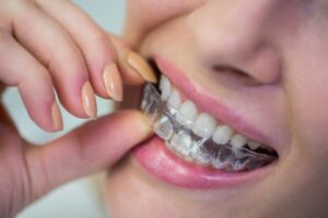 por qué usar retenedores después de la ortodoncia - sonrisa