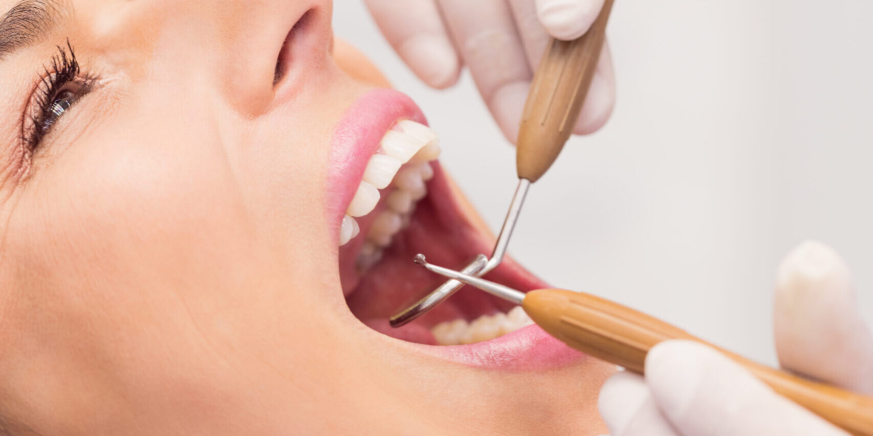limpieza dental en villanueva de la cañada – sarro limpieza dental en villanueva de la cañada - sarro