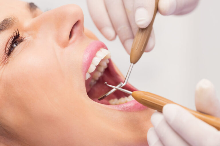 limpieza dental en villanueva de la cañada – sarro limpieza dental en villanueva de la cañada - sarro