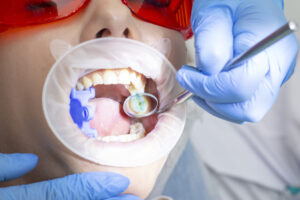 dentista-en-majadahonda-caries