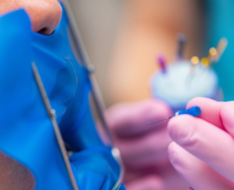 endodoncia en Villanueva del Pardillo - tratamiento