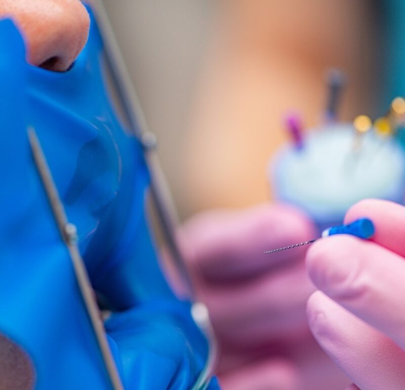 endodoncia en Villanueva del Pardillo - tratamiento