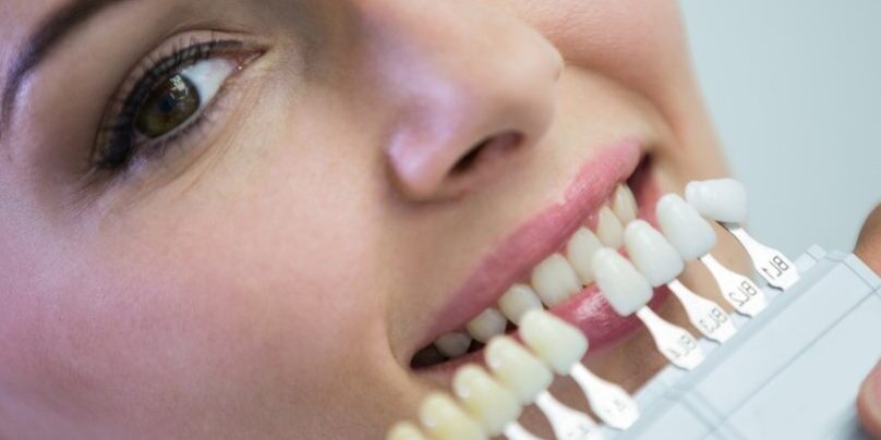 blanqueamiento en Brunete-dientes