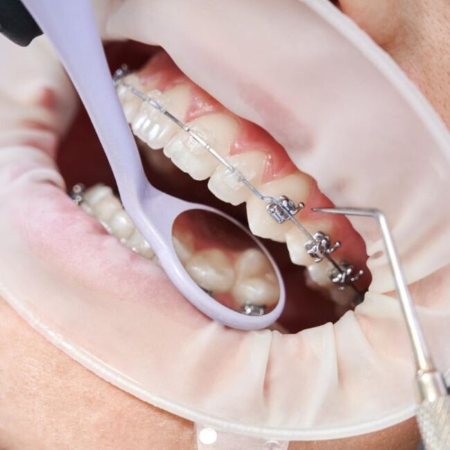 Ortodoncia en Villafranca del Castillo - Dentadura
