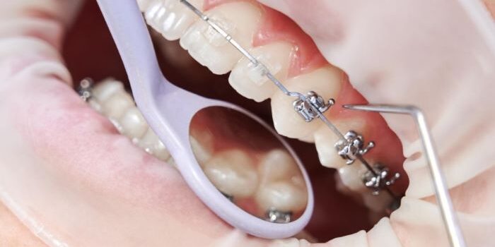 Ortodoncia en Villafranca del Castillo – Dentadura Ortodoncia en Villafranca del Castillo - Dentadura