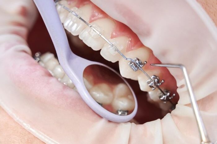 Ortodoncia en Villafranca del Castillo – Dentadura Ortodoncia en Villafranca del Castillo - Dentadura