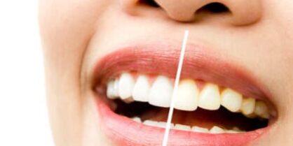 Blanqueamiento en Villanueva del pardillo – Brillo Blanqueamiento en Villanueva del pardillo - Brillo