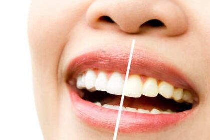 Blanqueamiento en Villanueva del pardillo – Brillo Blanqueamiento en Villanueva del pardillo - Brillo