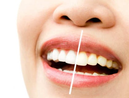 Blanqueamiento en Villanueva del pardillo - Brillo